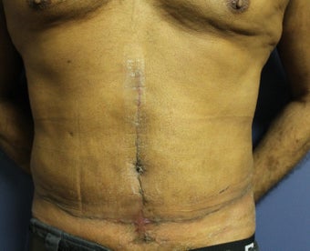55 year old male tummy tuck after 1064703