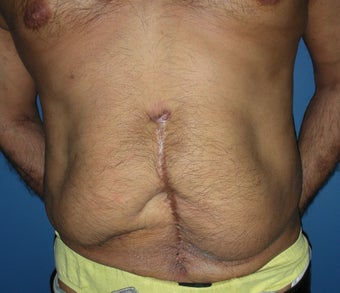 55 year old male tummy tuck before 1064703