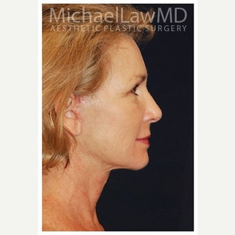 55-64 year old woman treated with Cheek Lift after 1550674