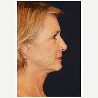 55-64 year old woman treated with Cheek Lift before 1550674