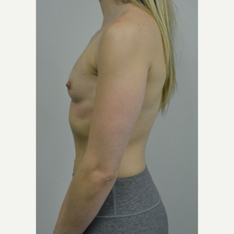 25-34 year old woman treated with Breast Implants who wants a natural look before 3644569