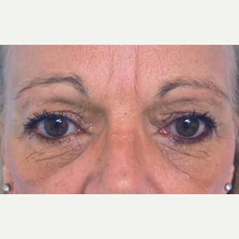 Eyelid Surgery (Blepharoplasty) before 3831627