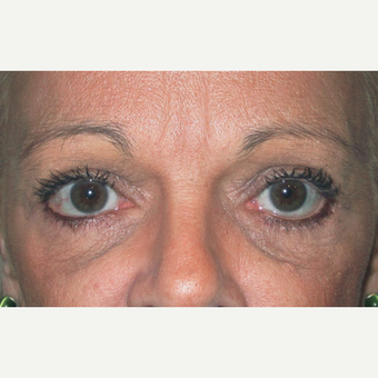 Eyelid Surgery (Blepharoplasty) after 3831627