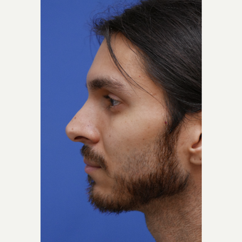Young man concerned with his large nose after 3786712