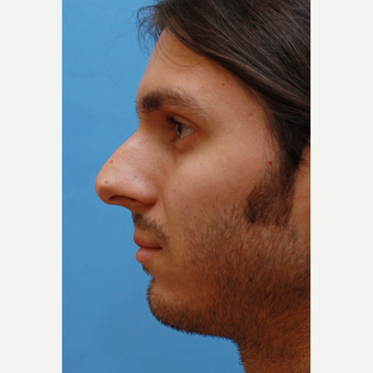 Young man concerned with his large nose before 3786712