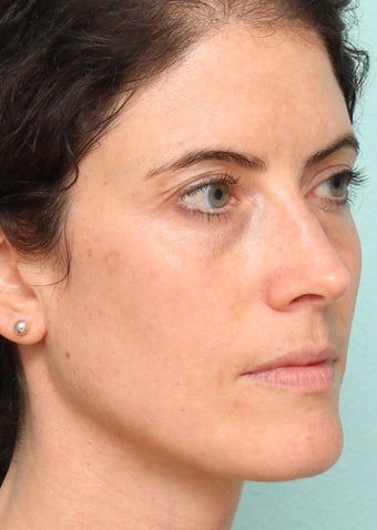 Sciton BBL and Microlaser peel - One Treatment, 2 weeks post op after 969745
