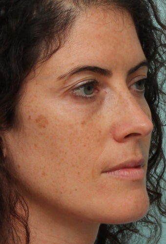 Sciton BBL and Microlaser peel - One Treatment, 2 weeks post op before 969745