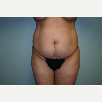 55-64 year old woman treated with Tummy Tuck before 3338759