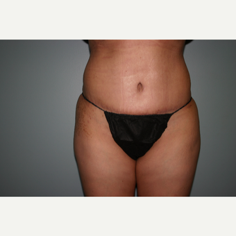 55-64 year old woman treated with Tummy Tuck after 3338759