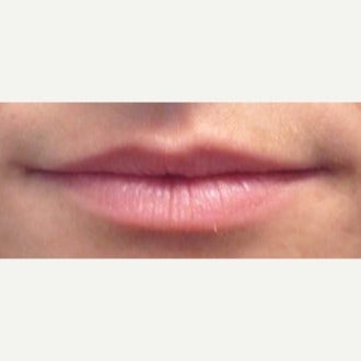 35-44 year old woman treated with Lip Augmentation before 2031220