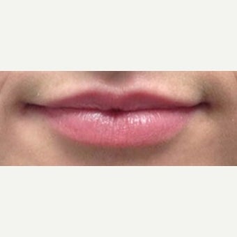 35-44 year old woman treated with Lip Augmentation after 2031220
