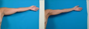 39-year-old woman treated with Liposuction. after 3287543