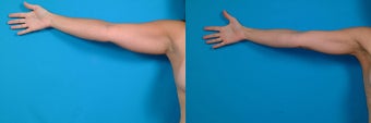 39-year-old woman treated with Liposuction. before 3287543