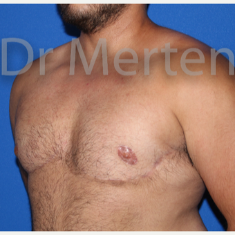 25-34 year old man treated with FTM Chest Masculinization Surgery after 3829004