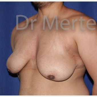 25-34 year old man treated with FTM Chest Masculinization Surgery before 3829004