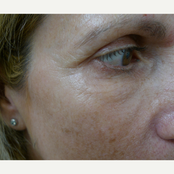 Juvederm for facial harmony after 2842417