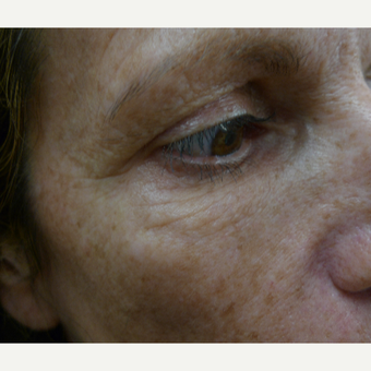 Juvederm for facial harmony before 2842417