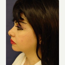 35-44 year old woman treated with Thread Lift after 2079277