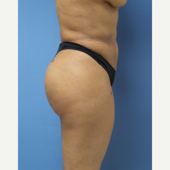 35-44 year old woman treated with Brazilian Butt Lift after 3696152