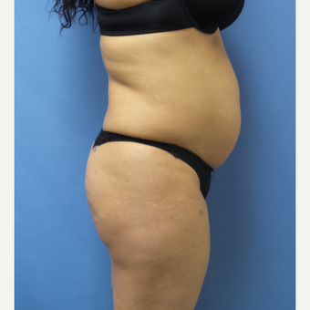 35-44 year old woman treated with Brazilian Butt Lift before 3696152