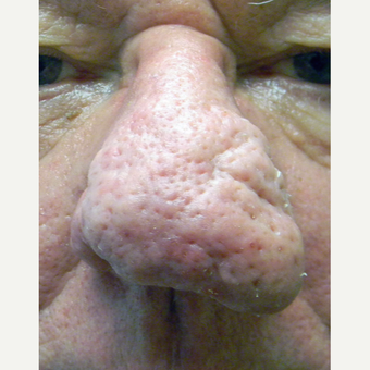 65-74 year old man treated Rhinophyma with CO2 Laser and wire loop electrocautery before 3321452