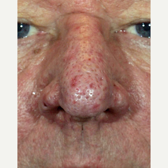65-74 year old man treated Rhinophyma with CO2 Laser and wire loop electrocautery after 3321452
