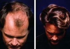 Hair replacement with Fleming/Mayer flap before 143619