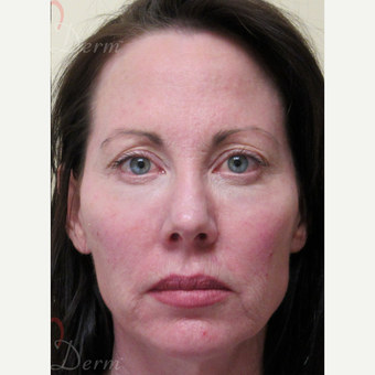 45-54 year old woman treated with Dysport after 3235373