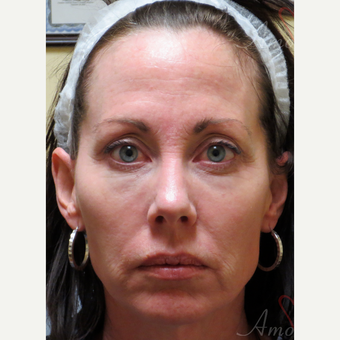 45-54 year old woman treated with Dysport before 3235373
