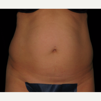 25-34 year old woman treated with Tummy Tuck 360 and SAFELipo before 2980046