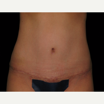 25-34 year old woman treated with Tummy Tuck 360 and SAFELipo after 2980046