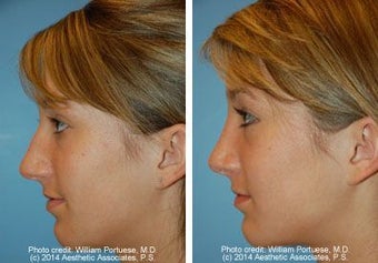 Rhinoplasty before 220833