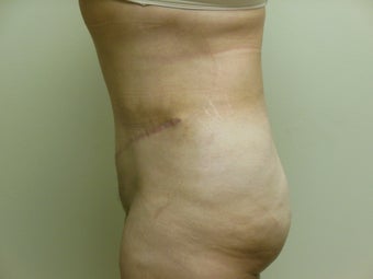 47 year old female desiring Tummy Tuck with Liposuction to Upper Abdomen and Flanks 1022172