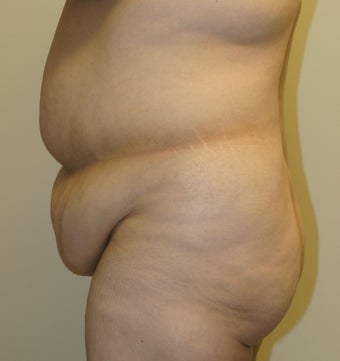 47 year old female desiring Tummy Tuck with Liposuction to Upper Abdomen and Flanks 1022172