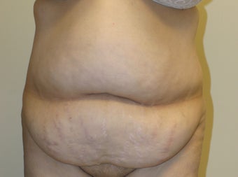 47 year old female desiring Tummy Tuck with Liposuction to Upper Abdomen and Flanks before 1022172