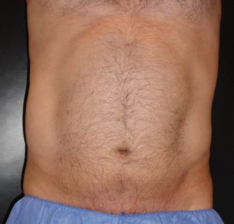 SmartLipo after 1264209