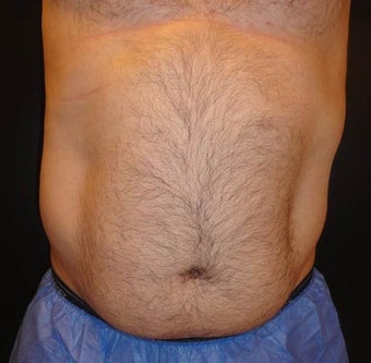 SmartLipo before 1264209