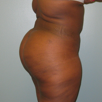 35-44 year old woman treated with Brazilian Butt Lift 1866219