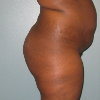 35-44 year old woman treated with Brazilian Butt Lift 1866219