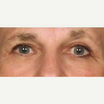 65-74 year old woman treated with Eyelid Surgery after 3286817