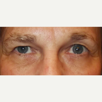 65-74 year old woman treated with Eyelid Surgery before 3286817