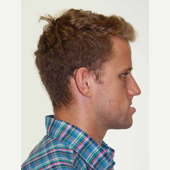 18-24 year old man treated with Orthognathic Surgery before 2419056