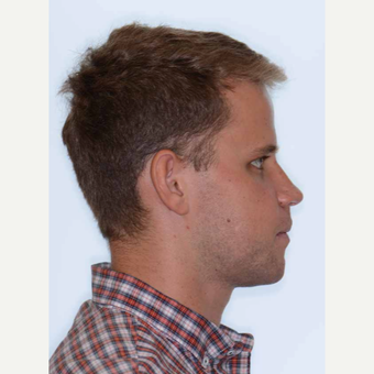 18-24 year old man treated with Orthognathic Surgery after 2419056
