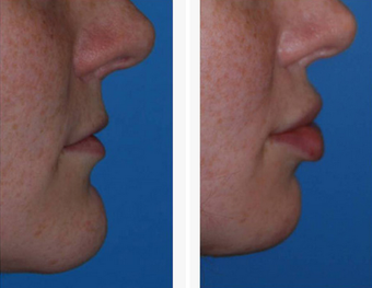 FFS Transgender Lip Enhancement VY Advancement before 1423929