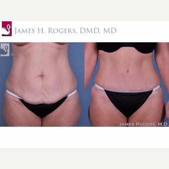 25-34 year old woman treated with Tummy Tuck before 3844267