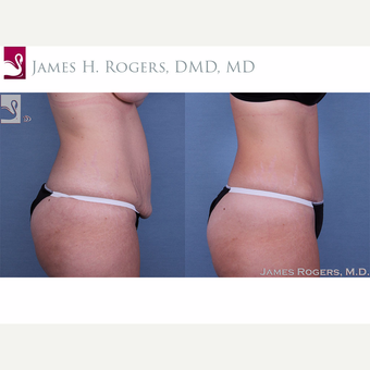25-34 year old woman treated with Tummy Tuck after 3844267