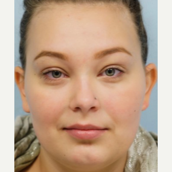 18-24 year old woman treated with Lip Augmentation before 3716267