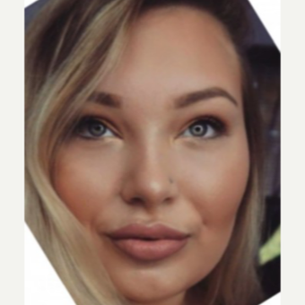 18-24 year old woman treated with Lip Augmentation after 3716267