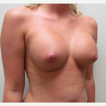 Saline Breast Implants for this 24 Year Old Woman after 3042898