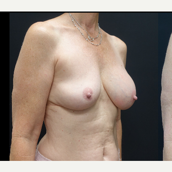 35-44 year old woman treated with Mentor Breast Implants before 3731637
